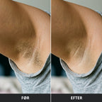 IPL Pro - Permanent hårfjerner